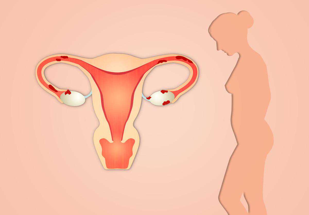 患有子宫内膜炎，会导致不孕？如要治疗，有2种对症治疗方式